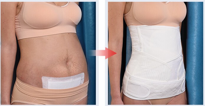 1 Postpartum C Section Recovery Belt Girdle Belly Binder Belly Wrap Girdle Post Pregnancy Waist Trainer Girdle Tummy Wrap